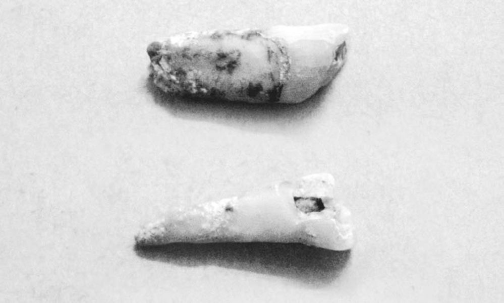 岩前镇猪仔笼洞出土的人类牙齿化石