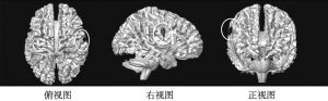 图3 右侧背侧脑岛静息态功能连接与受害者正义感分数显著相关的脑区